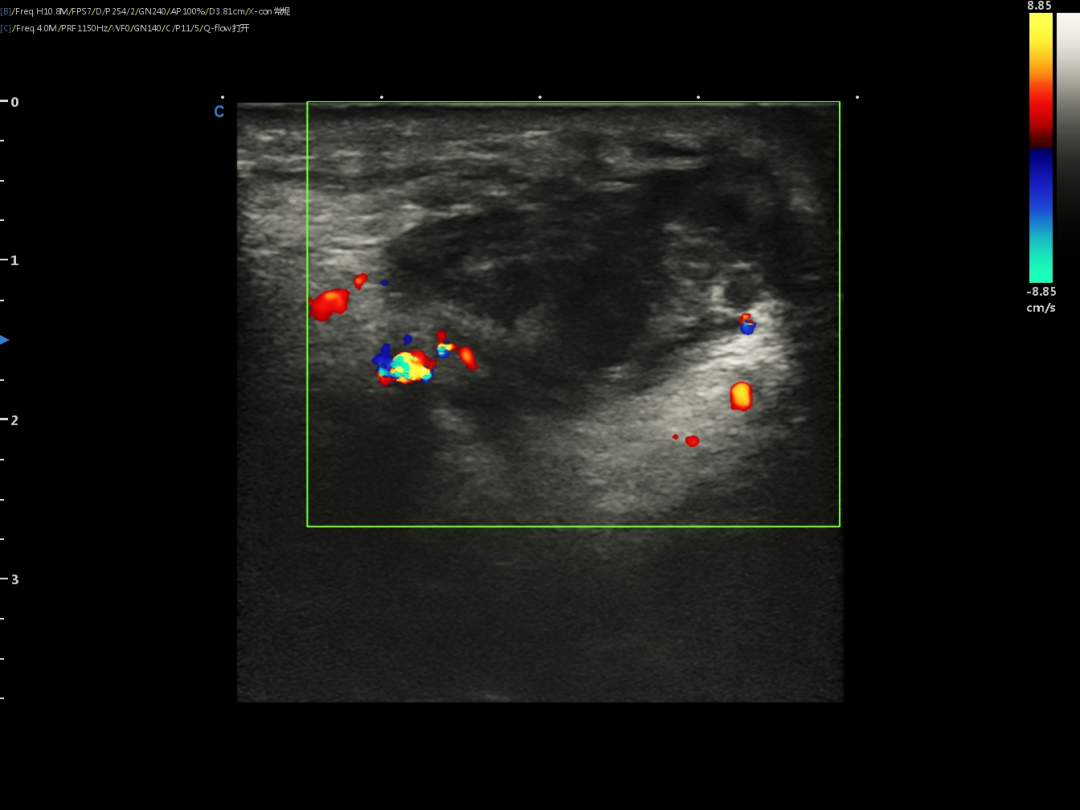 Ultrasound guided puncture of subcutaneous tumor in the neck