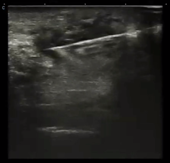 Ultrasound guided puncture of subcutaneous tumor in the neck