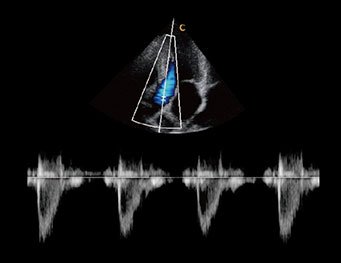 Aorta Valve,PW Mode