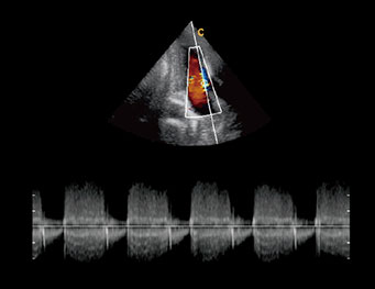 Cardiac Two Chambers,CW Mode