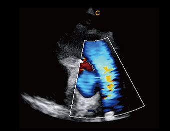 Aorta Short Axis View,C Mode