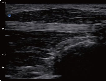 Flexor Tendon, Longitudinal View