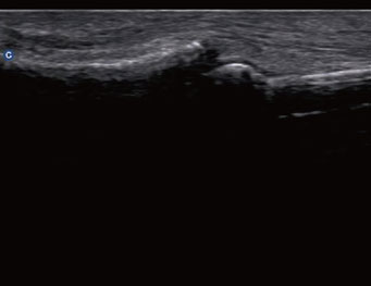 lnterhalangeal Tendon,B Mode