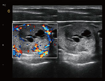 Thyroid multiple adenomas, B or BC Mode