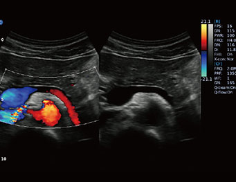 Pancreas, B or BC Mode