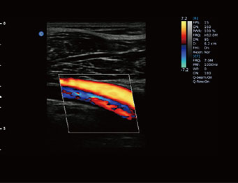 Popliteal Artery and Vein