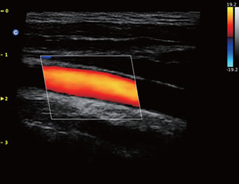 Carotid, 2D steer