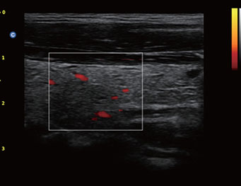 Thyroid, CPA Mode