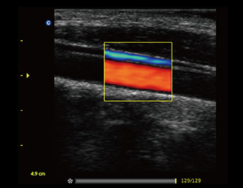 Carotid Artery, C Mode