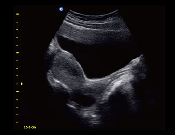 Uterus, B Mode