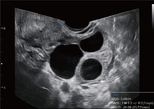 Sonda Transvaginal Gran Angular