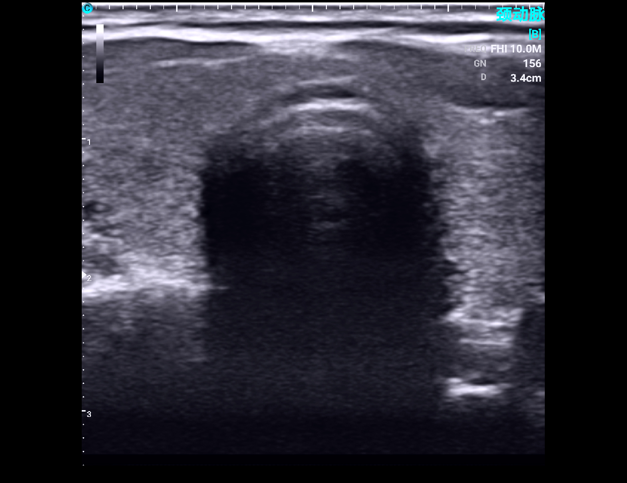 Trachea, B Mode