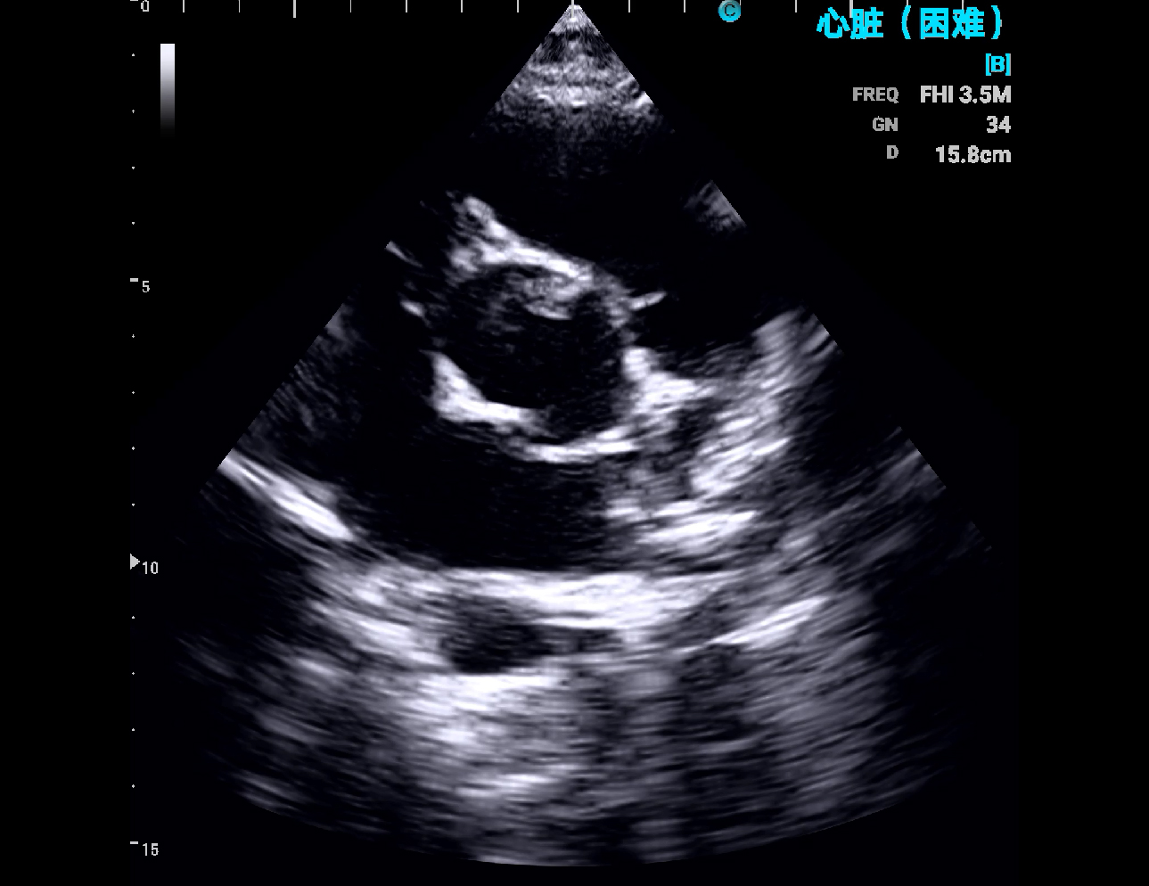 Cardiac, B Mode