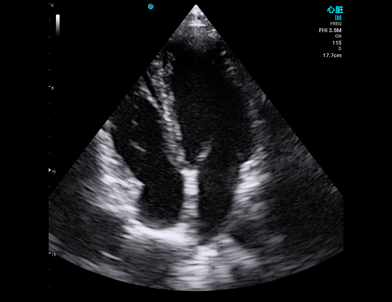 Cardiac, B Mode