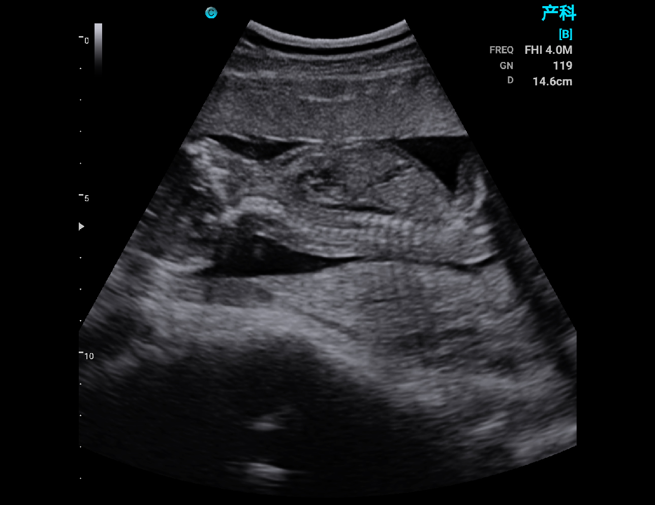 Fetal spine, B Mode