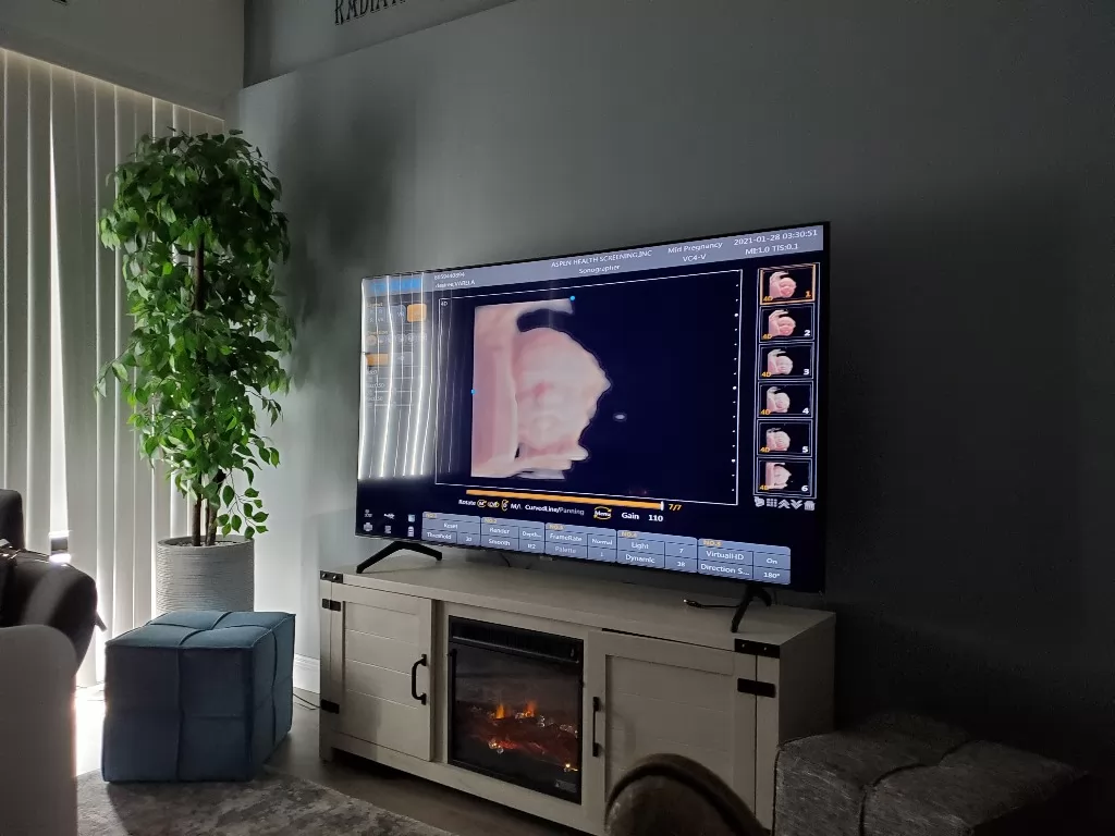 3D ultrasound can also be used to diagnose chromosomal abnormalities and congenital defects.  3D ultrasound can also be used to diagnose chromosomal abnormalities and congenital defects.