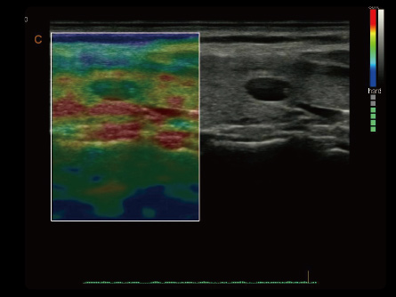 Quantitative Elastography