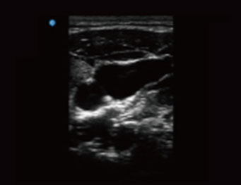 Central Venous Access.B Mode